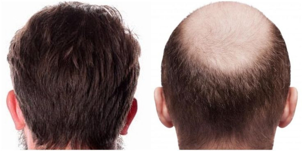 Hair Transplant in Dubai FUE Technique Explained