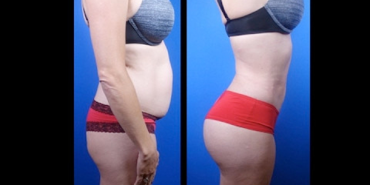 Buttock Augmentation in Dubai Recovery Expectations Guide