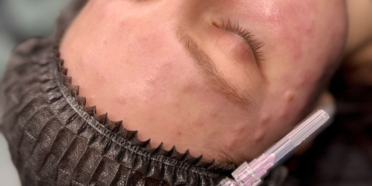 The Science of Volift Fillers in Dubai: Why They Last Longer