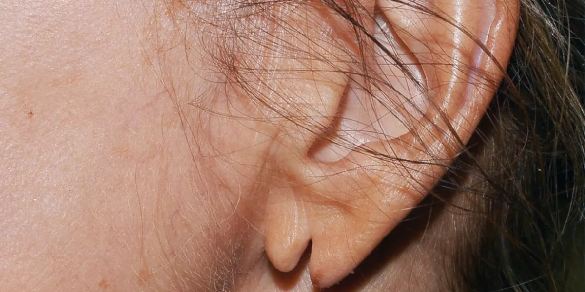 Clinics Setting New Standards for Earlobe Correction Surgery
