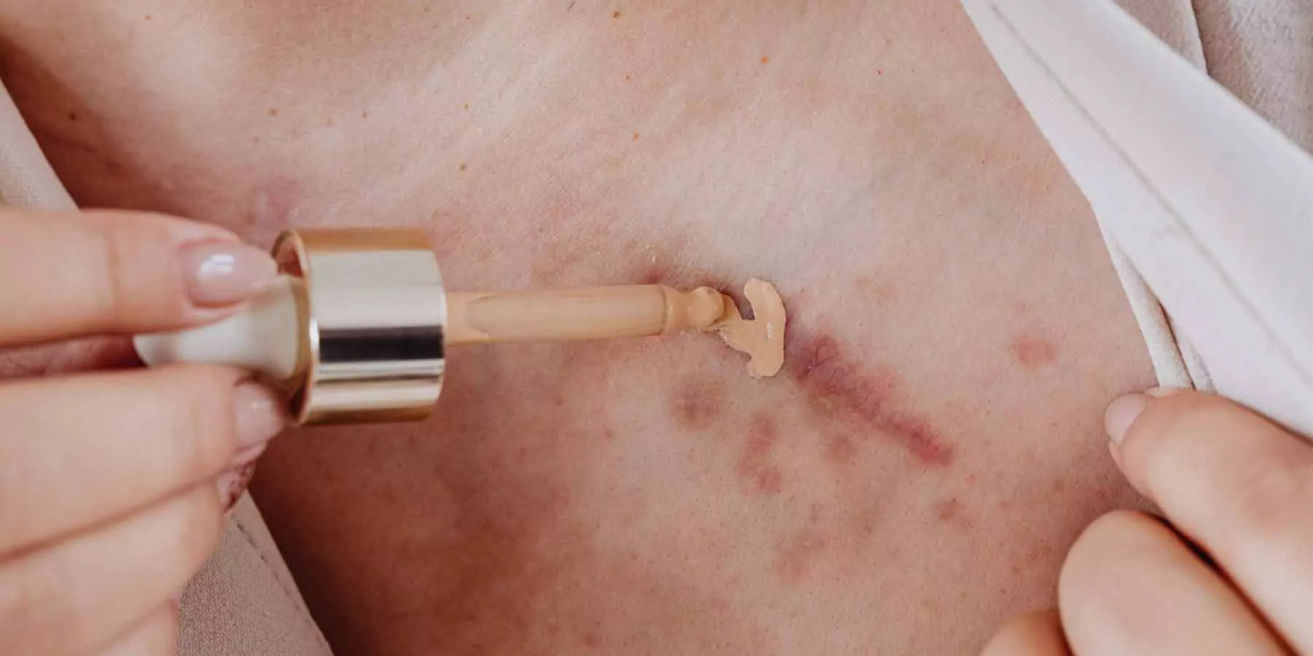 How Scar Camouflage Differs from Laser Scar Treatments