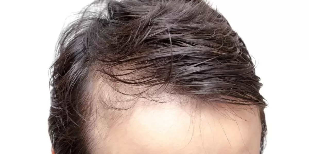 Advanced Technology Transforming Hair Restoration Procedures