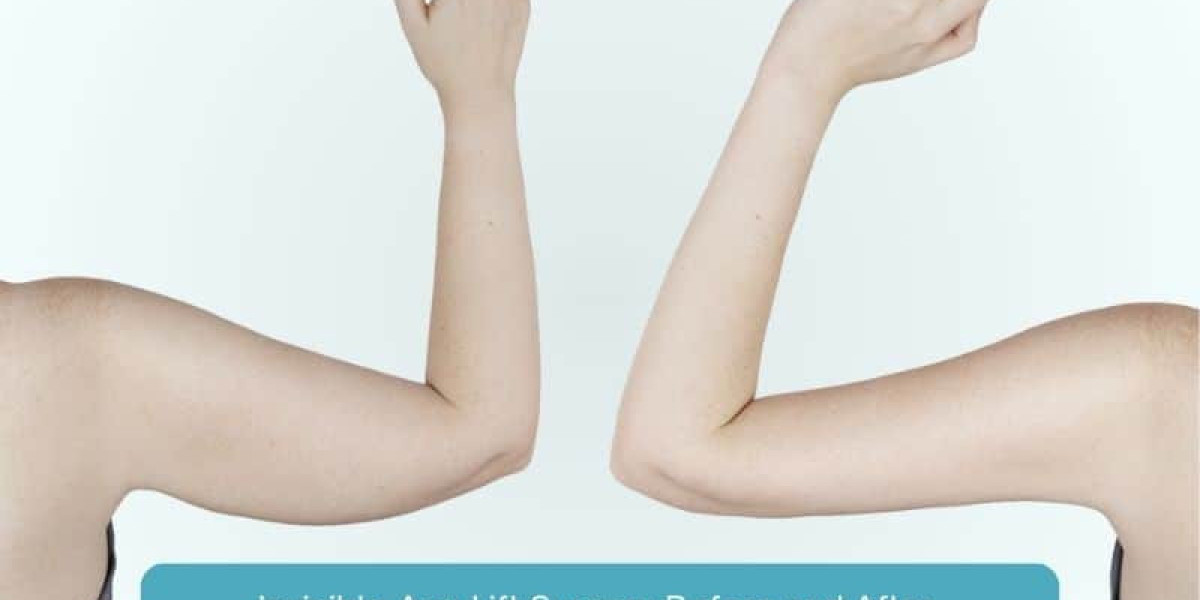 Restoring Confidence with Arm Lift Surgery in Jeddah