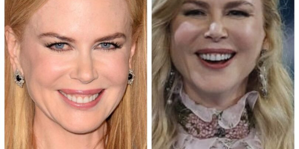 Nicole Kidman Plastic Surgery: Facts, Speculation, and Public Discussion