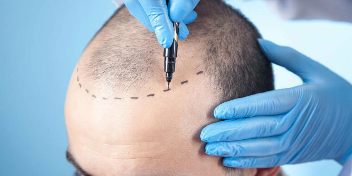 Hair Transplant in Buraydah for Alopecia Patients