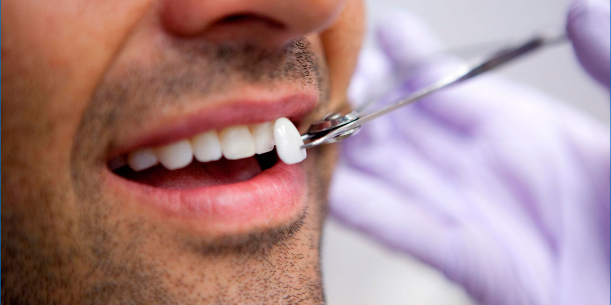 Top Reasons to Choose Veneers in Islamabad for a Smile Transformation