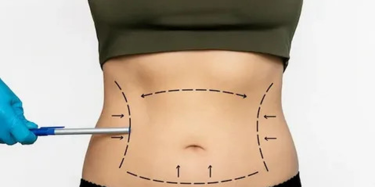Liposuction in Dubai: Comprehensive Body Shaping