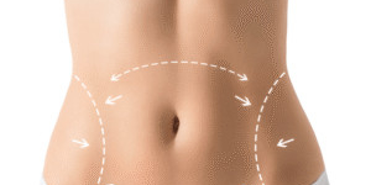 Liposuction in Dubai: Achieving Smooth, Natural Results