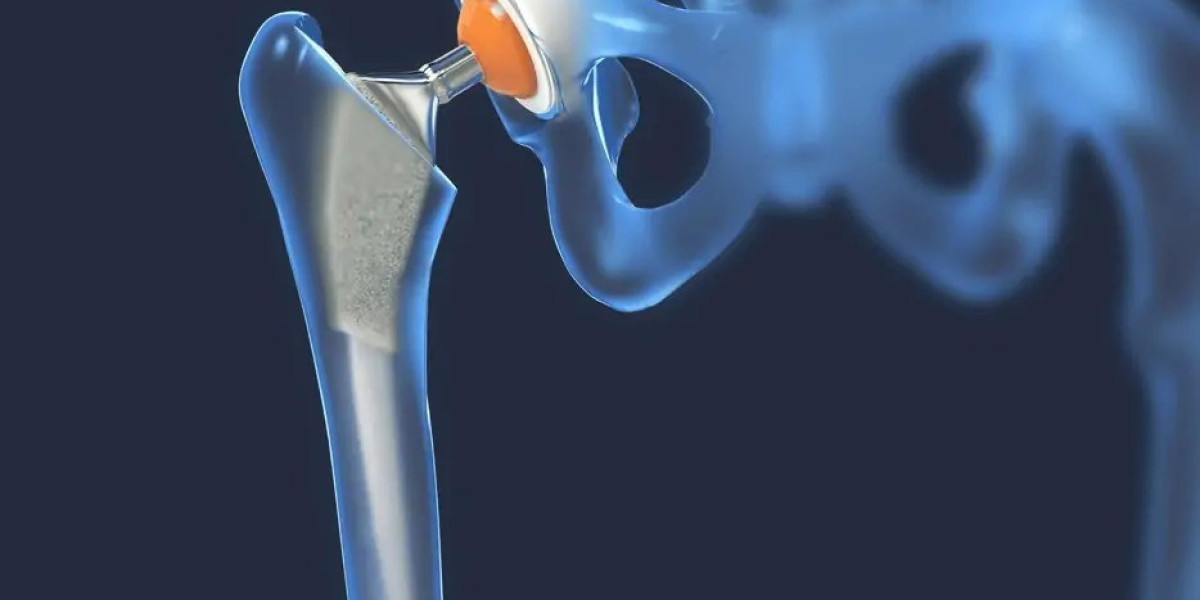How Modern Hip Replacement Techniques Improve Results