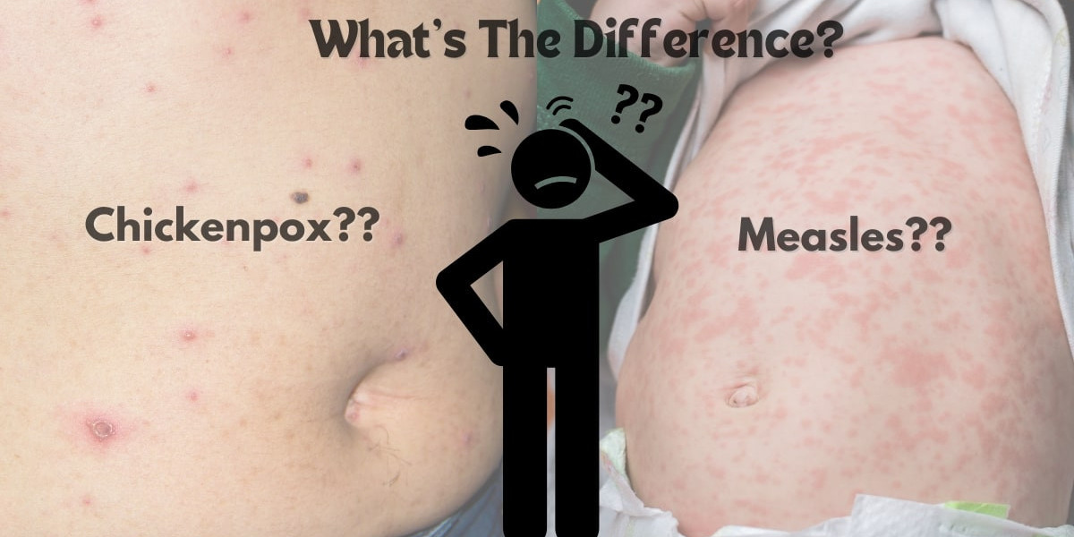 Chicken Pox Measles Difference: How to Tell These Viral Infections Apart