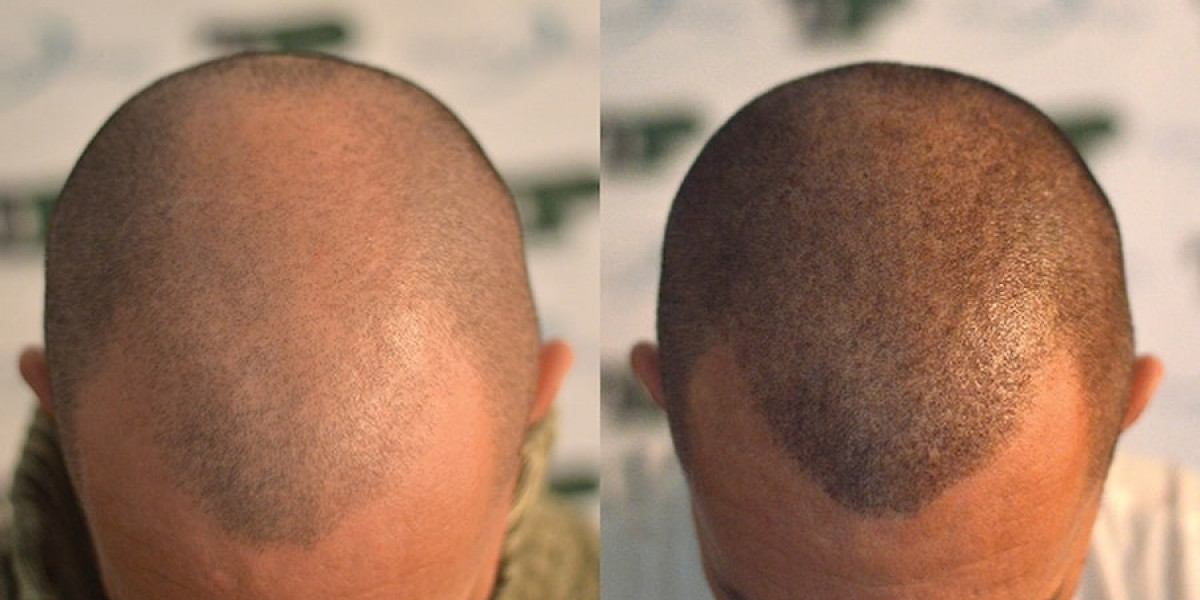 1 Dirham Hair Transplant in Dubai: Essential Facts