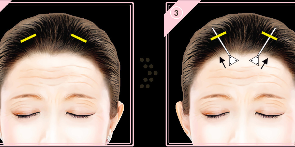 2. The Science of Neuromodulators Post-Surgery: Locking in Your Results