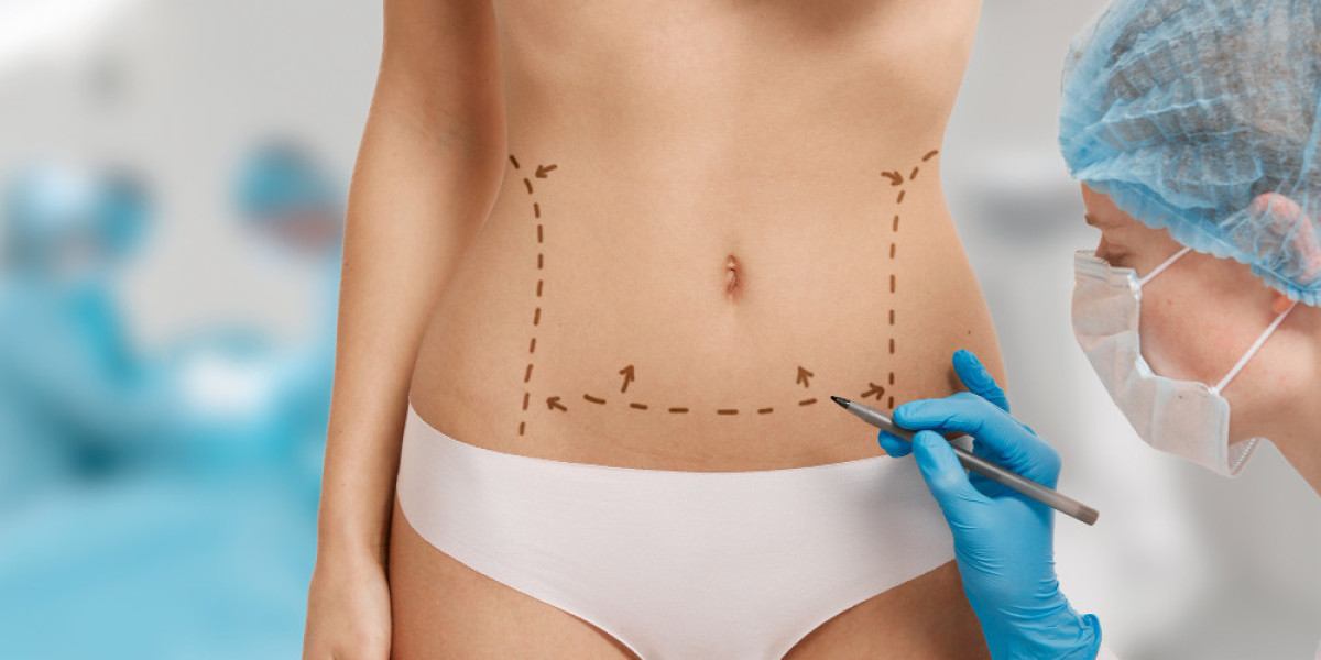 Is Liposuction Permanent? Everything You Need to Know