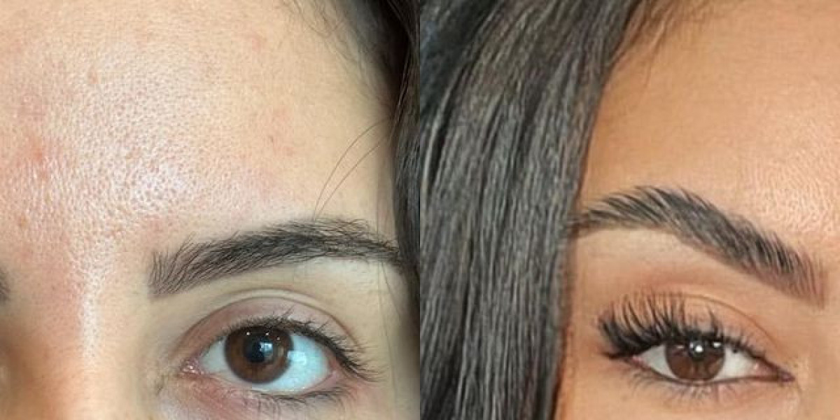 Understanding the Benefits and Procedures of Brow Lift Surgery in Riyadh