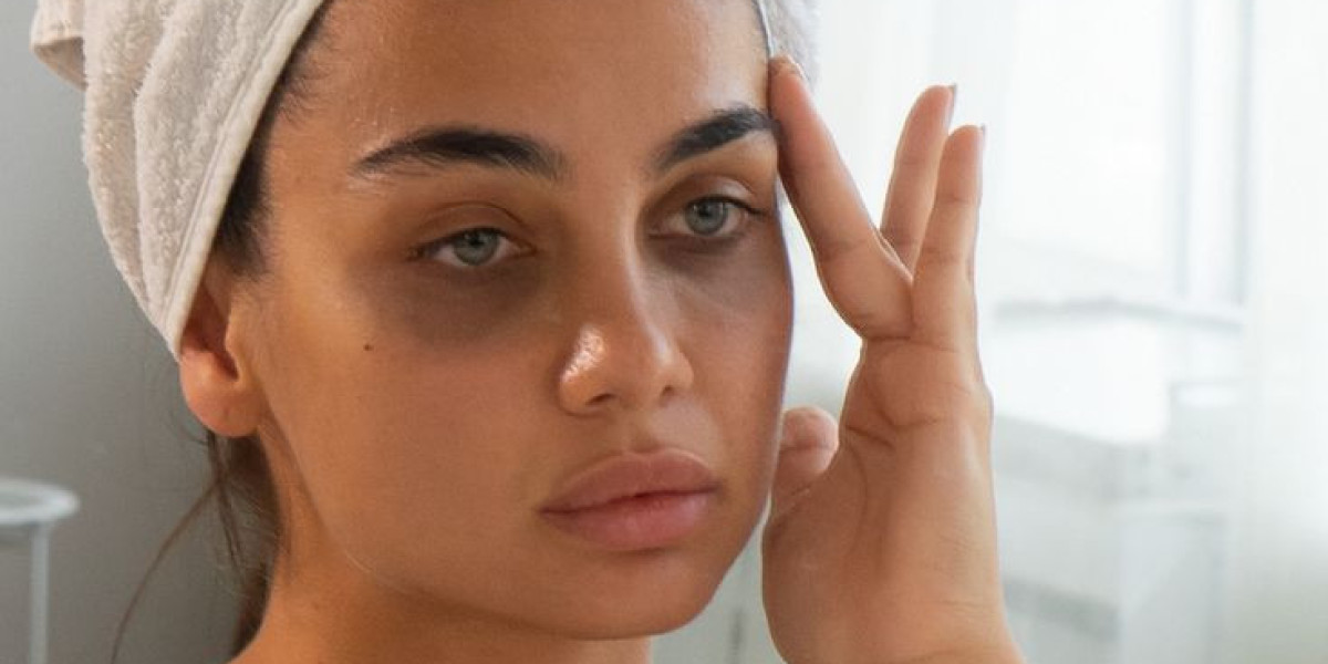 Dark Circles Treatment in Islamabad: Effective Solutions for Stubborn Under-Eye Shadows