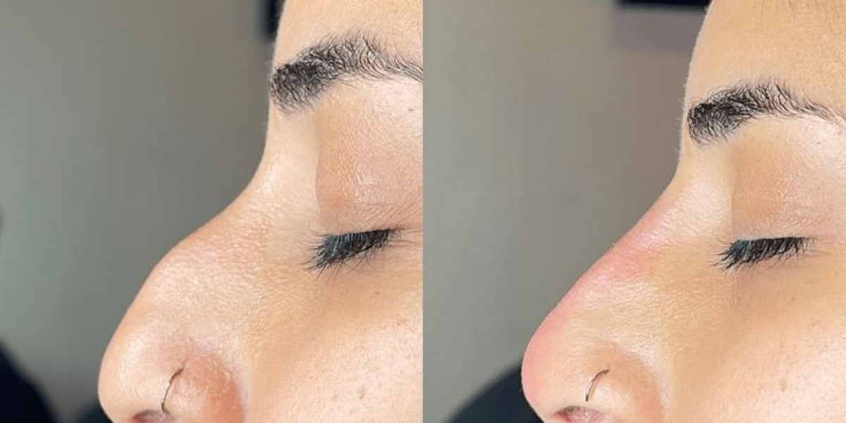 Can Liquid Rhinoplasty in Dubai Improve Symmetry