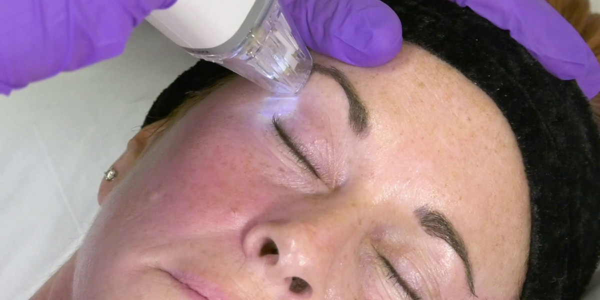 Fractional RF Microneedling in Dubai Recovery Tips