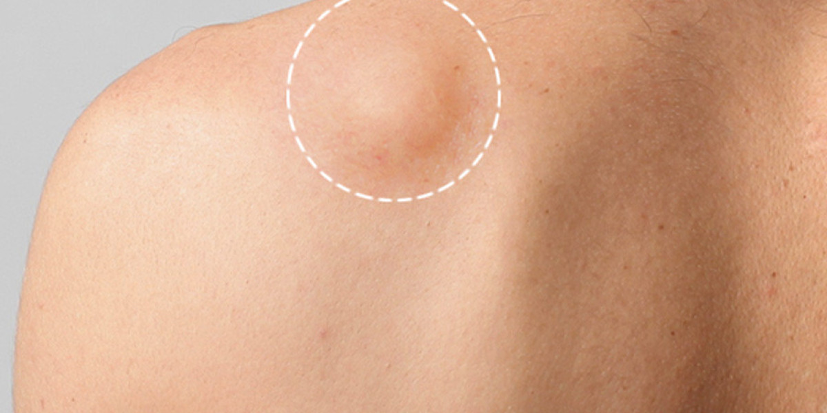 Best Trusted Locations for Lipoma treatment in Dubai