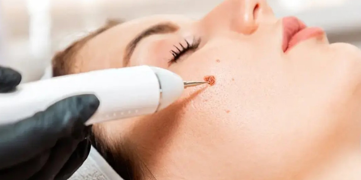 Technology Used in Modern Mole Removal Methods