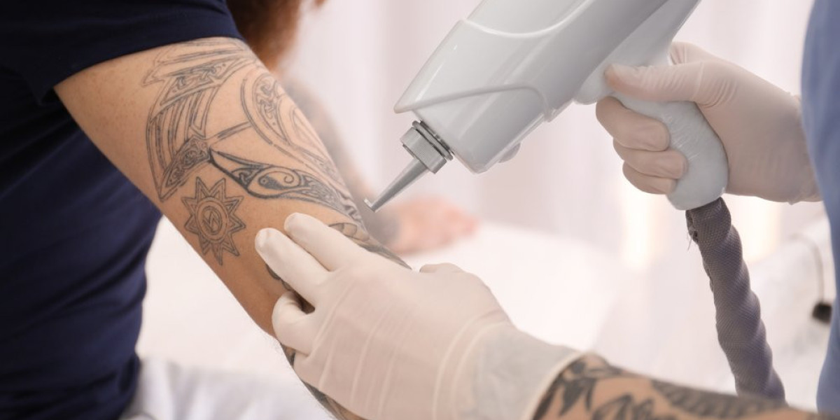 Tattoo Removal in Riyadh for Sensitive Skin