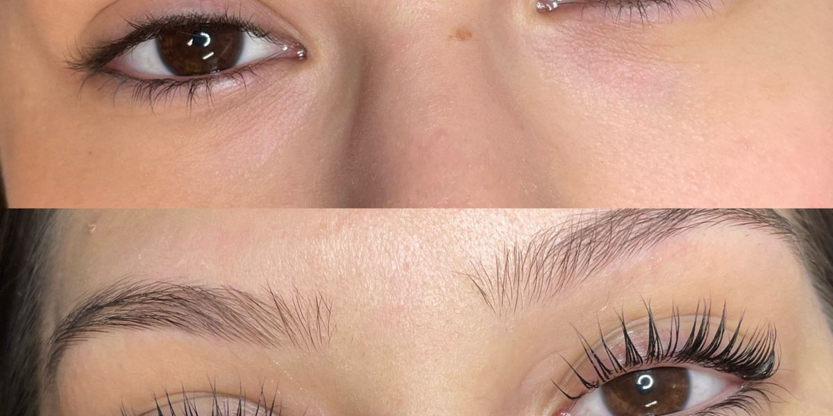 Eyelash Hair Transplant in Dubai: Proven Medical Results