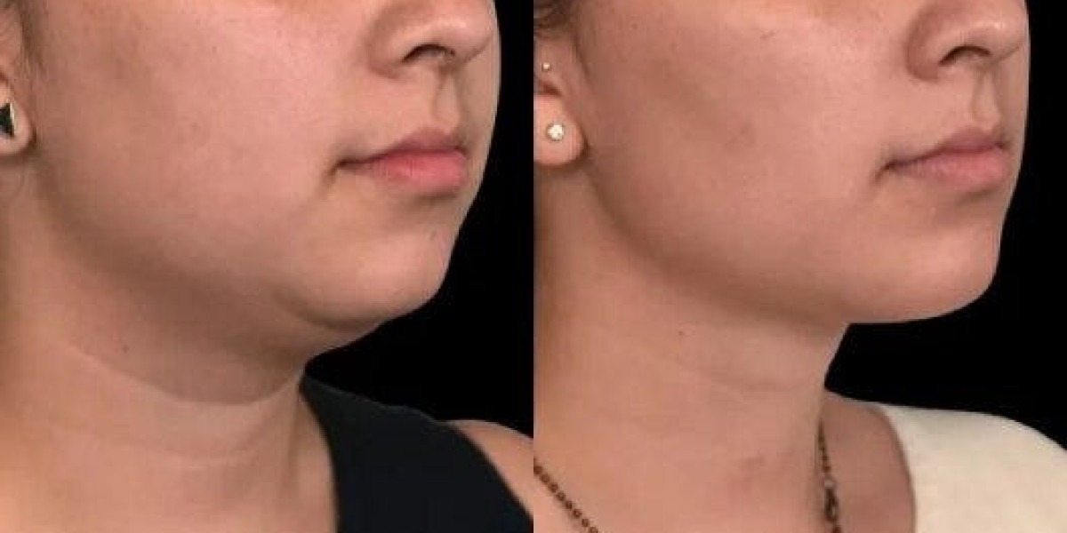 Comprehensive FAQ on Submental Contouring and Double Chin Procedures