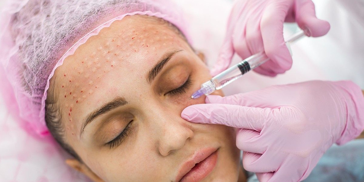 Mesotherapy in Islamabad: Renew Your Skin Naturally with Advanced Aesthetic Care