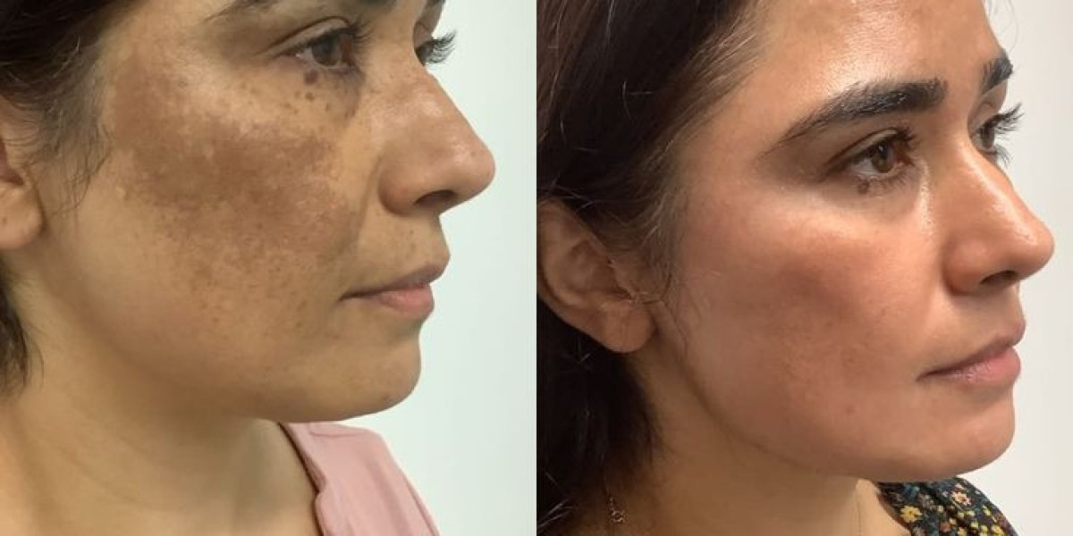Skin Pigmentation in Dubai: Climate Effects on Skin