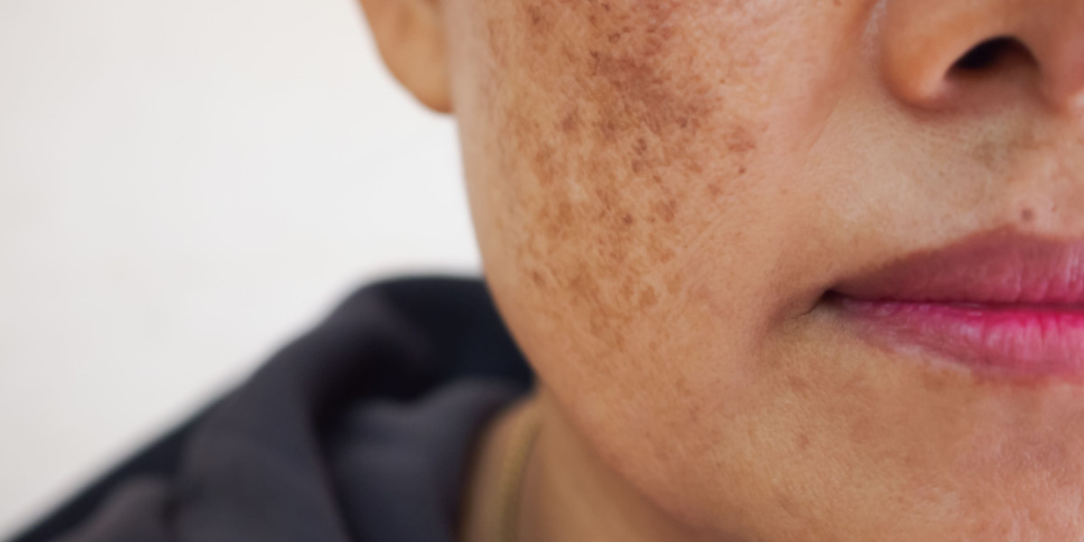 Skin Pigmentation in Dubai: Effective Skin Care Guide