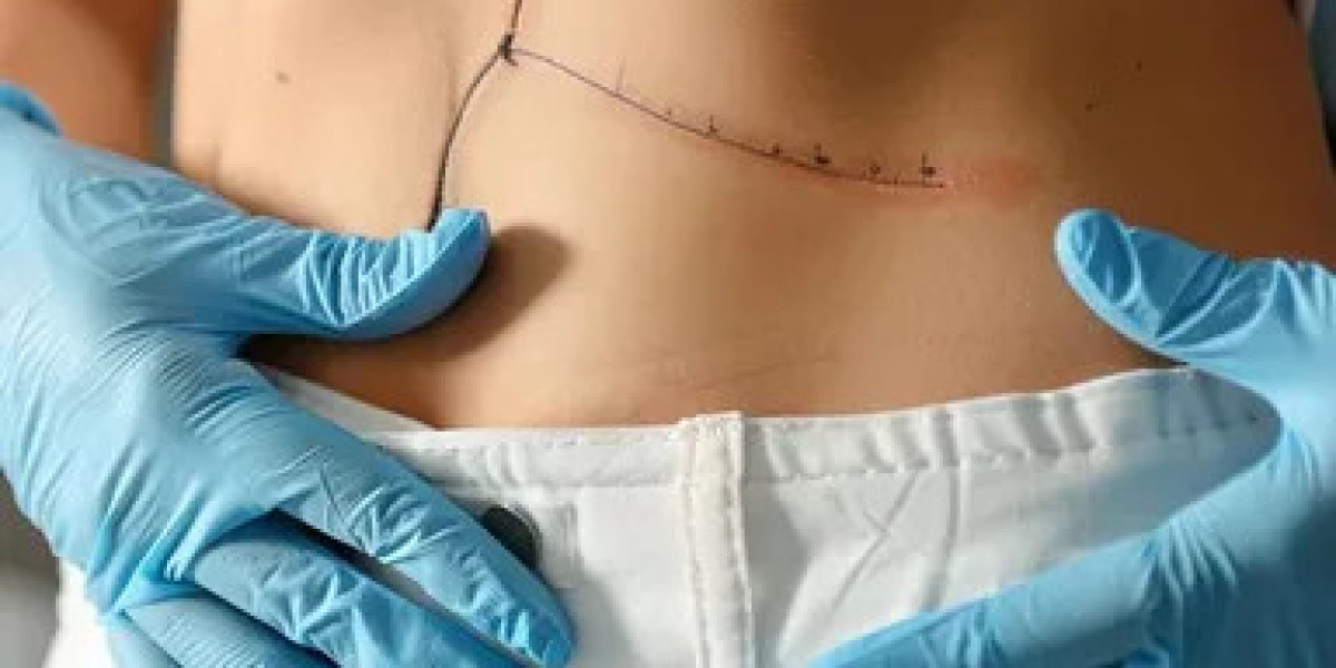 Tummy Tuck in Dubai: Why Patients Choose Expert Care