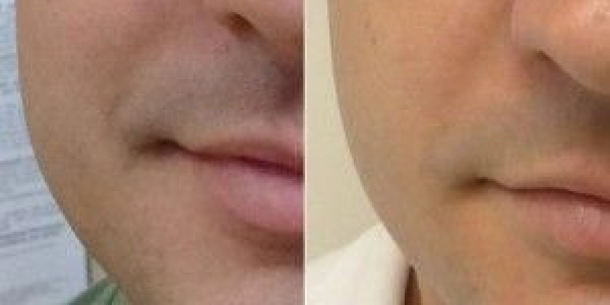 Mole removal in Dubai: Achieving Flawless Skin Tone