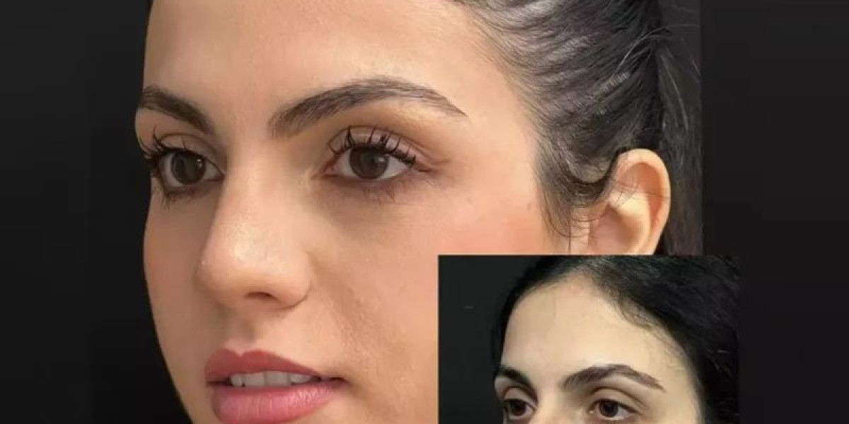Rhinoplasty Surgery in Dubai for Nose Correction