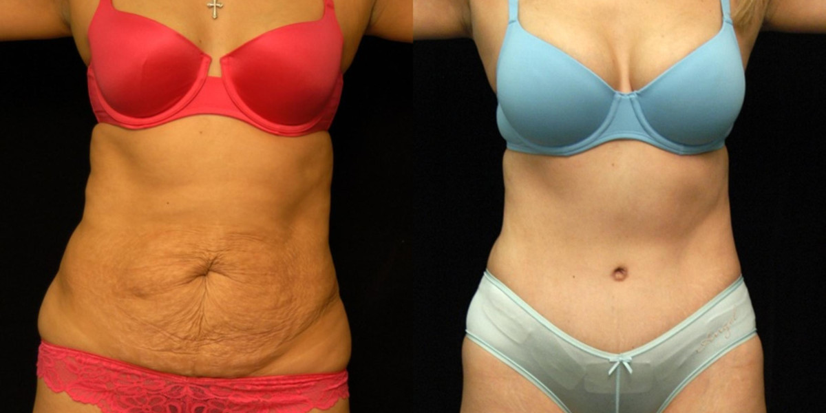 Mommy Makeover Dubai: Combining Multiple Procedures
