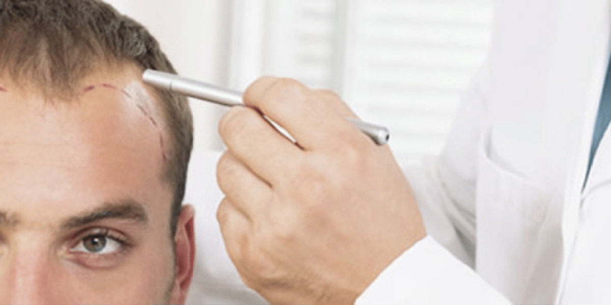 Hair Transplant in Dubai and Treatment Benefits