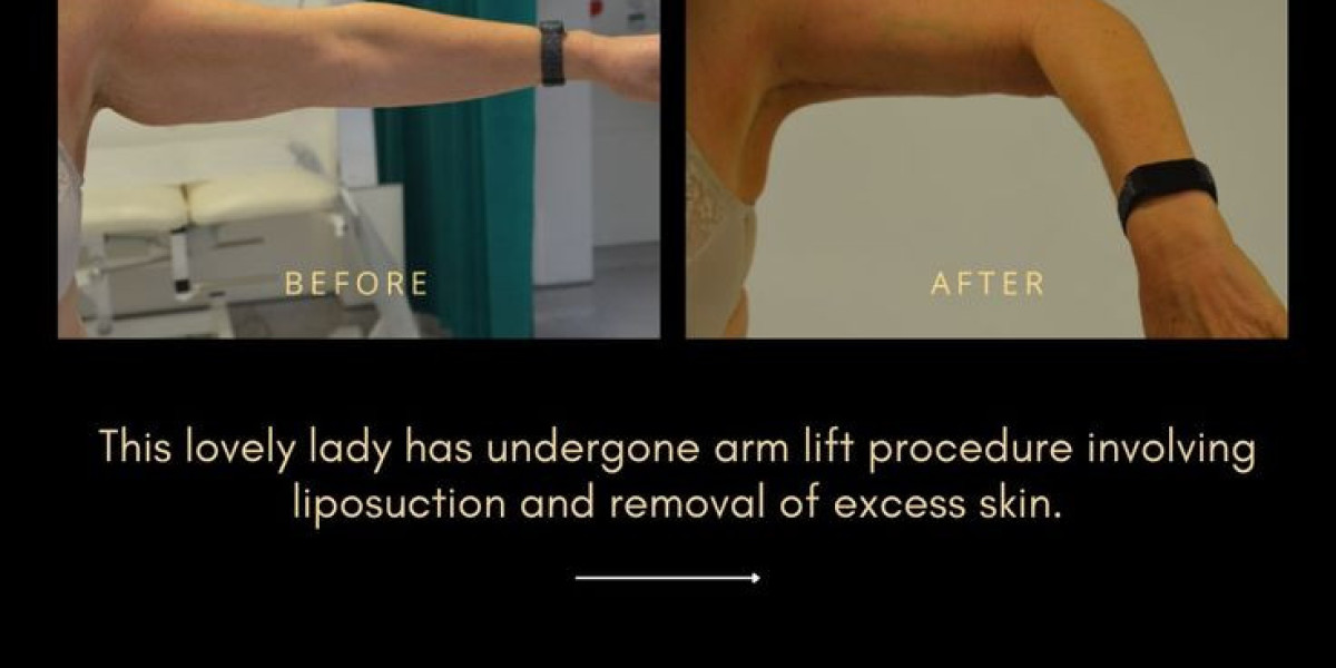 Comprehensive Guide to Arm Lift Surgery in Jeddah: Part 10 – Managing Risks, Complications, and Revision Strategies