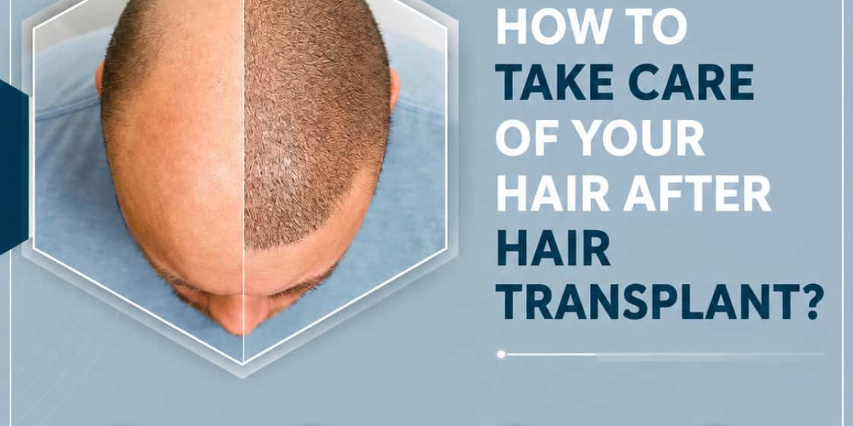 Hair transplant Maintenance Tips: How to Care for Your New Hair