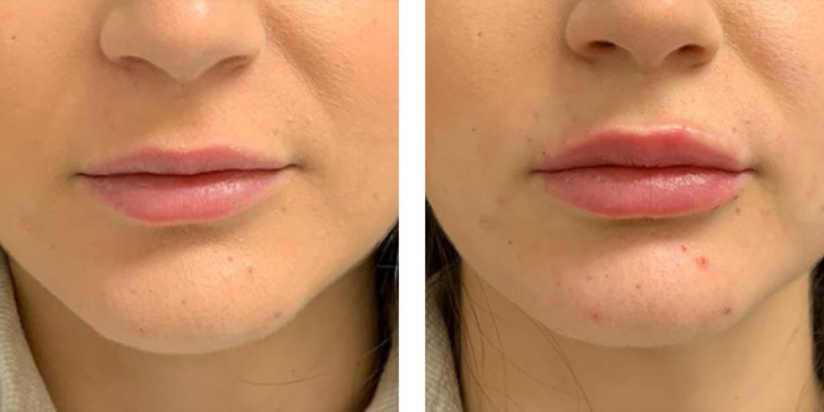 Lip Augmentation in Jeddah: A Complete Guide to Fuller, Youthful, and Natural-Looking Lips