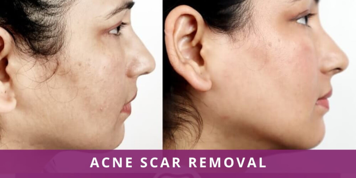 Acne Scar Removal in Jeddah: A Guide to Achieving Smoother and More Even-Looking Skin