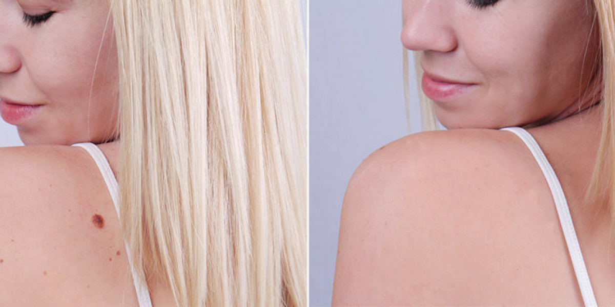 Birthmark Removal in Jeddah: Benefits, Considerations, and Expected Results