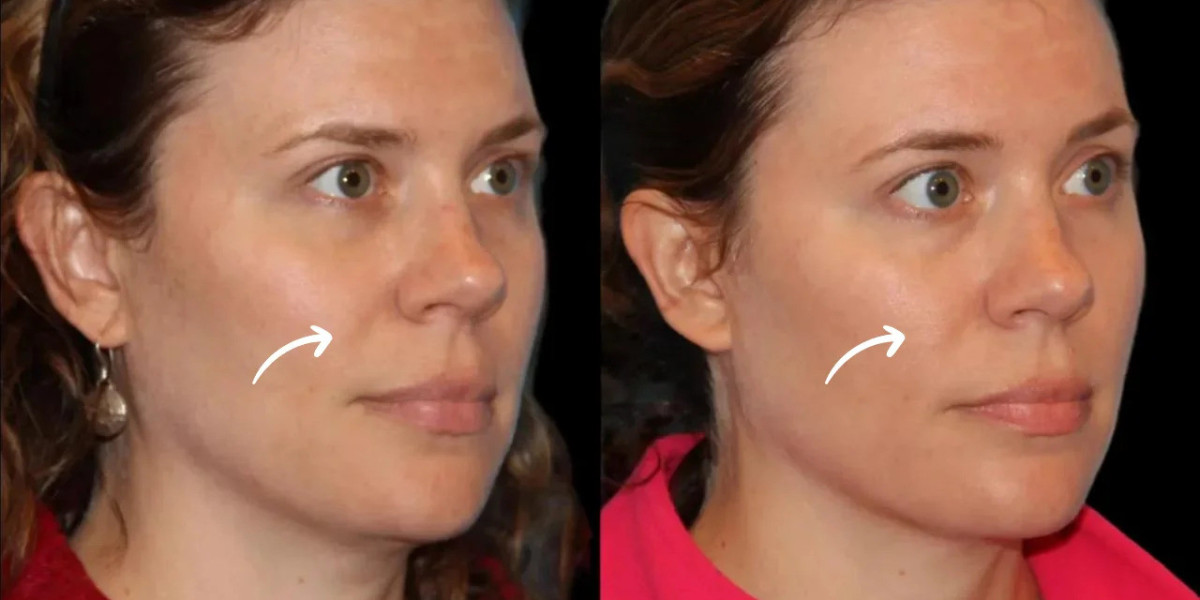 Best Aesthetic Clinic in Dubai for Sculptra Fillers Fold Assessment
