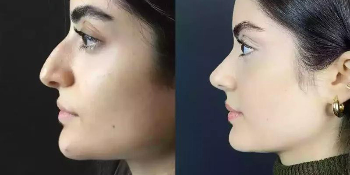 Rhinoplasty Dubai: Before and After Expectations