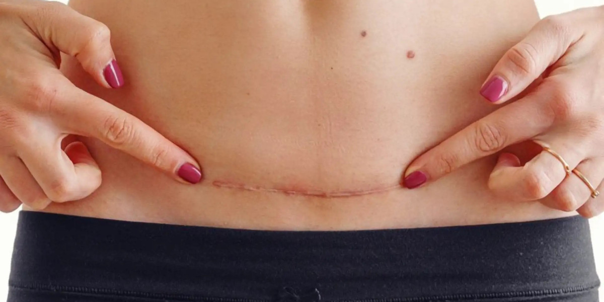Does Surgical Scar Revision Help Smooth Uneven Scar Formations?