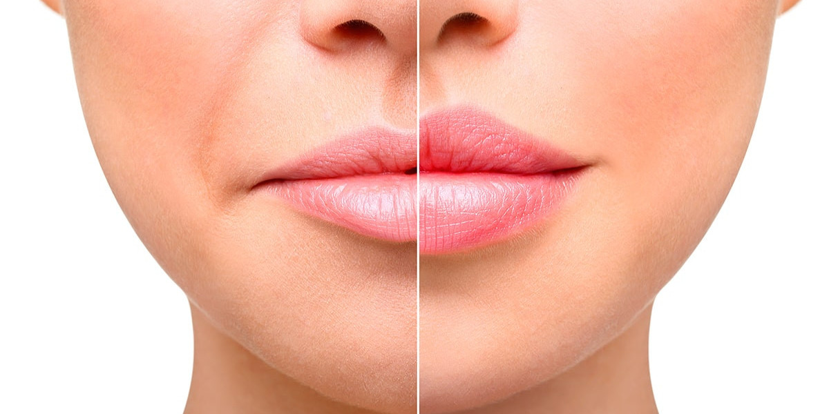 Lip Augmentation in Jeddah for a Fuller Upper Lip