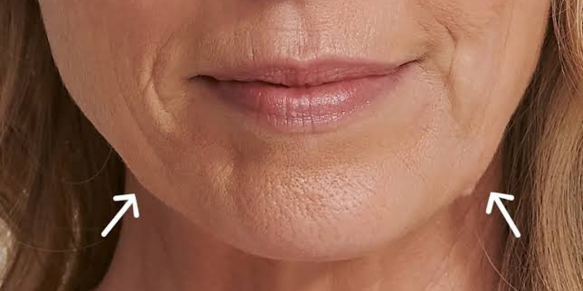 Thread Lift in Dubai for Sagging Skin