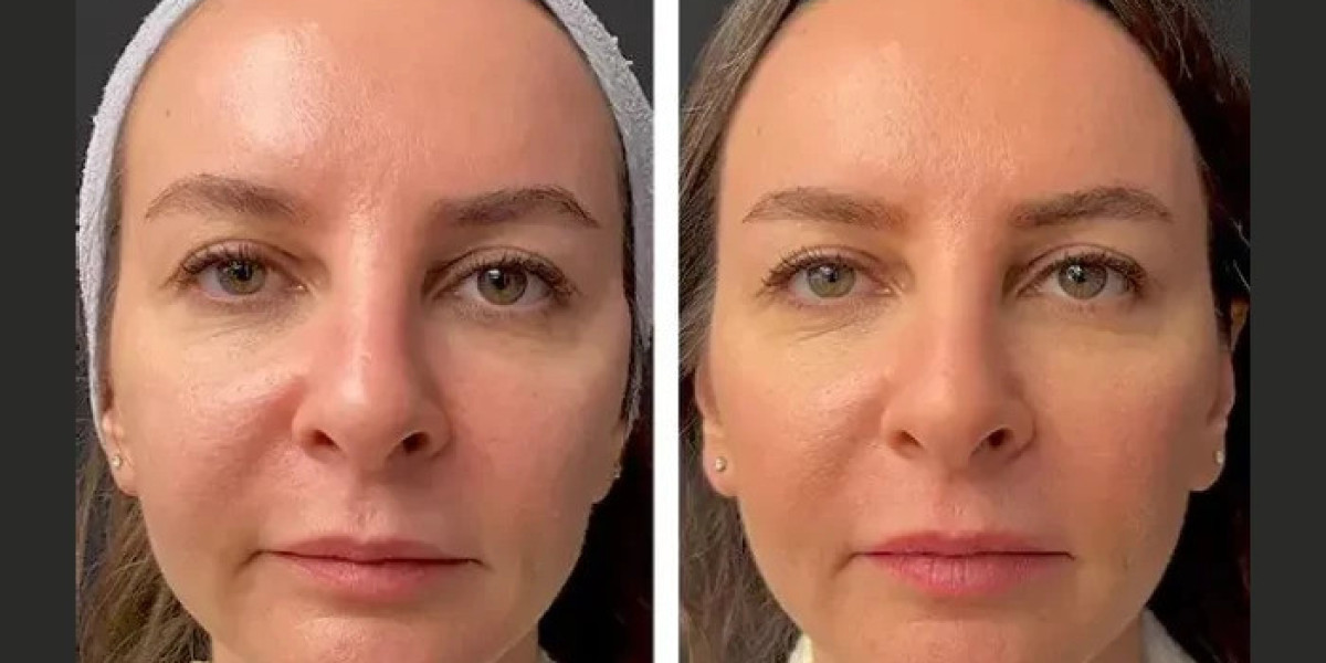 Best Aesthetic Clinic in Dubai for Mesotherapy: You See Results?