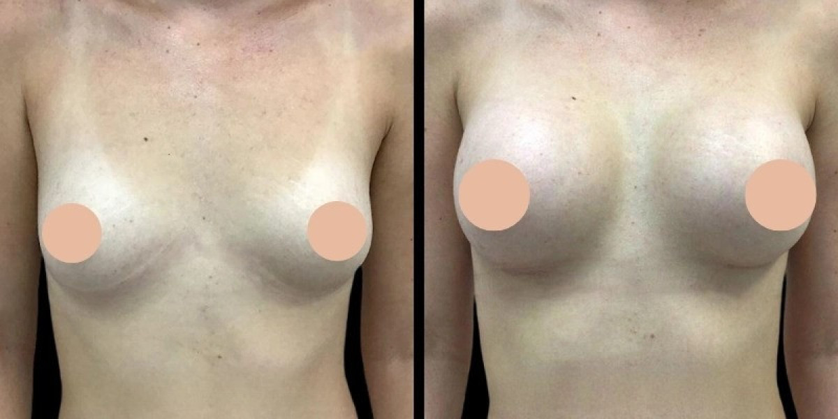 Breast Augmentation in Dubai: Understanding Different Breast Implant Options