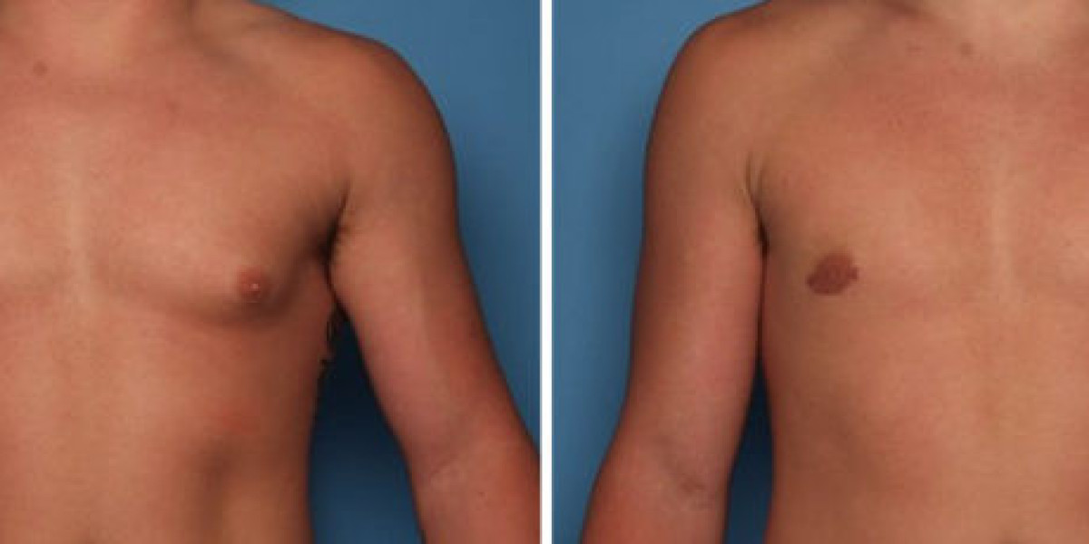Gynaecomastia Surgery in Dubai: Explore Options