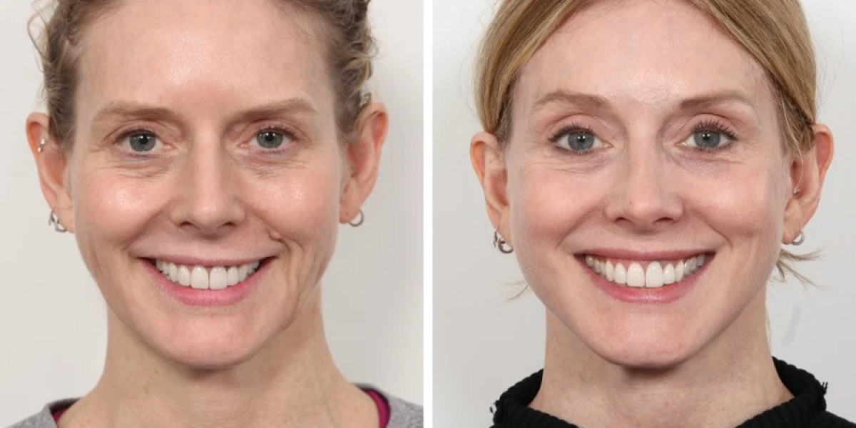 Best Doctors in Dubai for Youthful Thread Lift Results
