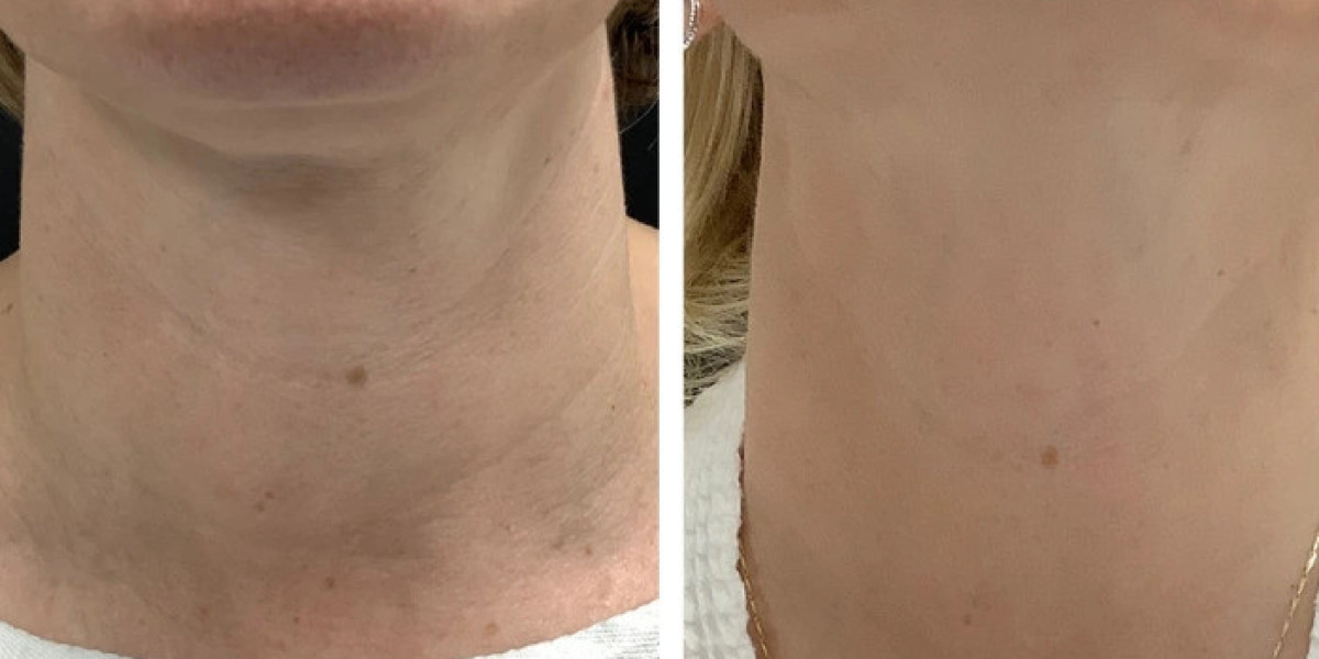 Radiofrequency (RF) Microneedling treatments in Dubai for Collagen Support