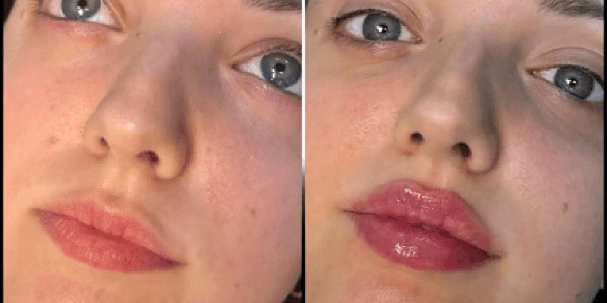 Fillers Treatments in Dubai for a More Youthful Appearance